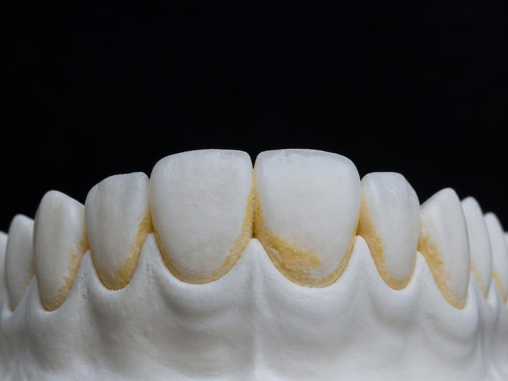 Close-up of teeth with plaque build-up along the gumline after manual brushing